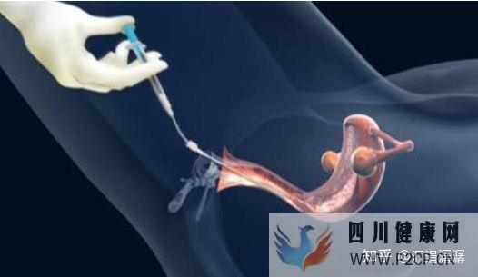 導(dǎo)致習(xí)慣性流產(chǎn)的原因(圖2) 導(dǎo)致習(xí)慣性流產(chǎn)的原因(圖2)