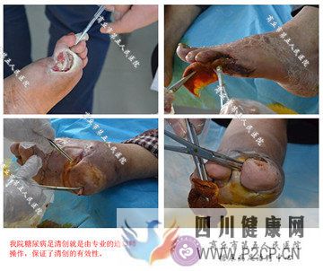 糖尿病導致足部潰爛應該怎么治療？(圖1)