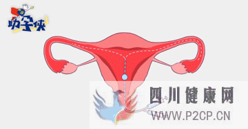 輸卵管不通怎么辦!(圖4)