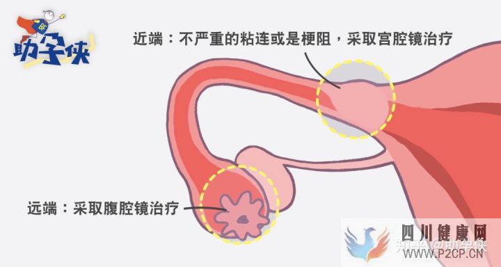輸卵管不通怎么辦!(圖7)