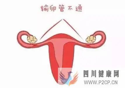 女性為什么會出現(xiàn)輸卵管堵塞？(圖1)