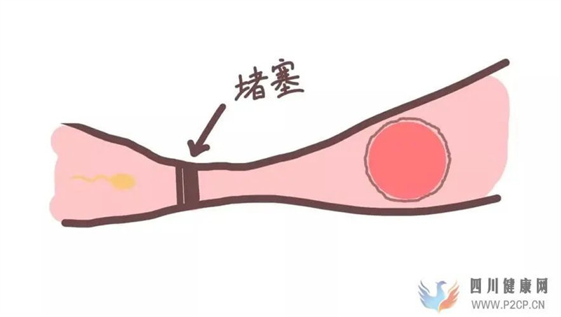 輸卵管堵塞的癥狀表現(xiàn)？(圖1)
