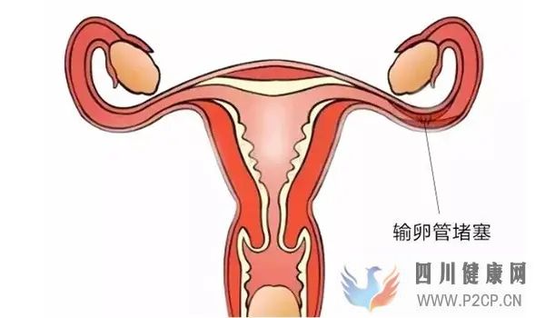 輸卵管堵塞有什么辦法可以懷孕(圖1) 輸卵管堵塞有什么辦法可以懷孕(圖1)