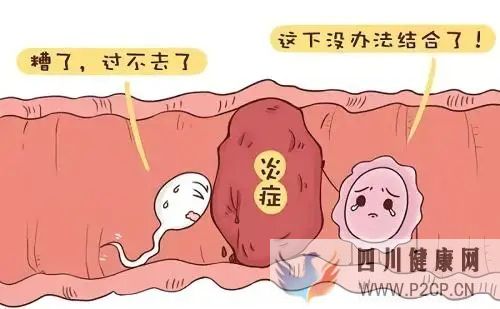 輸卵管炎癥性不孕的癥狀(圖1) 輸卵管炎癥性不孕的癥狀(圖1)