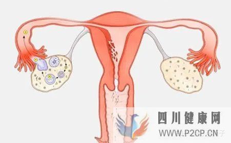 不孕癥的自我診斷(圖4)