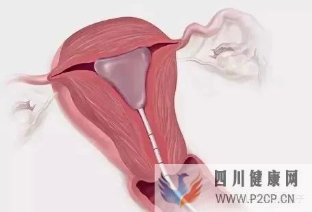 不孕癥的自我診斷(圖7)