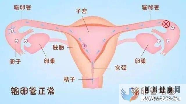 治療不孕癥，為什么往往從“輸卵管造影”開始？(圖2)