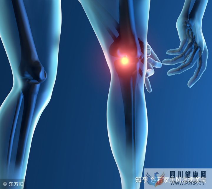 風濕的癥狀有哪些該如何預防風濕真相馬上揭曉(圖2) 風濕的癥狀有哪些該如何預防風濕真相馬上揭曉(圖2)
