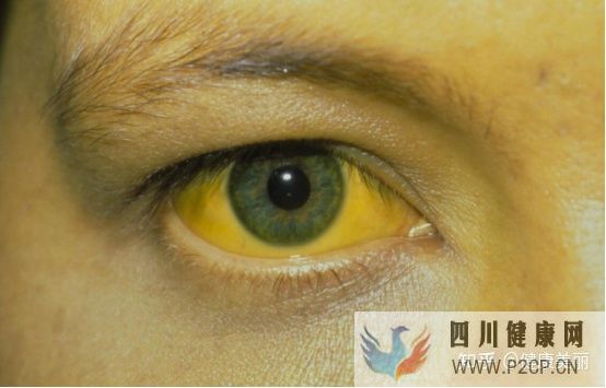 肝病患者長什么樣真的和正常人不同嗎(圖4)