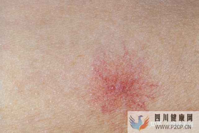 肝病患者長什么樣真的和正常人不同嗎(圖6)