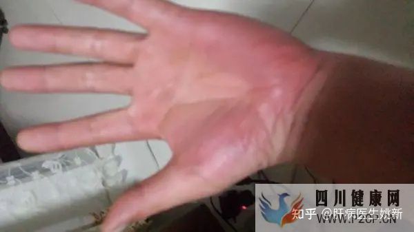 肝病早期的五大癥狀(圖9) 肝病早期的五大癥狀(圖9)