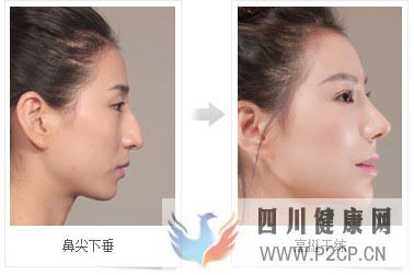 美容整形前一定要知道的美容整形知識(圖6)