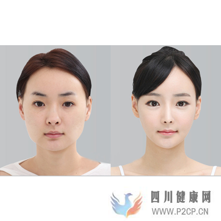 美容整形前一定要知道的美容整形知識(圖7)