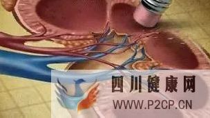 她患糖尿病只有5年，就必須透析治療，為避免悲劇重演，一定要學(xué)會(huì)這5個(gè)預(yù)防糖尿病腎病的方法(圖1)