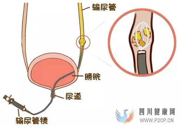 得了腎結(jié)石怎么治療比較好？(圖1)