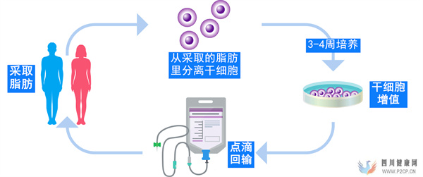 慢性腎臟病腎功能不全的概述及導致問題日本干細胞如何治療(圖3) 慢性腎臟病腎功能不全的概述及導致問題日本干細胞如何治療(圖3)
