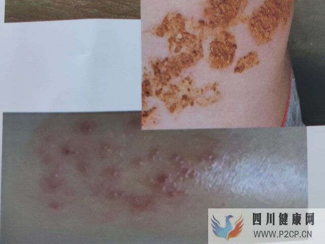 移植后長(zhǎng)帶狀皰疹了會(huì)降低著床成功率