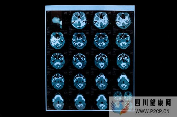 呼吸道病毒感染潮蔓延背后,CT正在被濫用?(圖3) 呼吸道病毒感染潮蔓延背后,CT正在被濫用?(圖3)