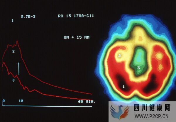 呼吸道病毒感染潮蔓延背后,CT正在被濫用?(圖5) 呼吸道病毒感染潮蔓延背后,CT正在被濫用?(圖5)