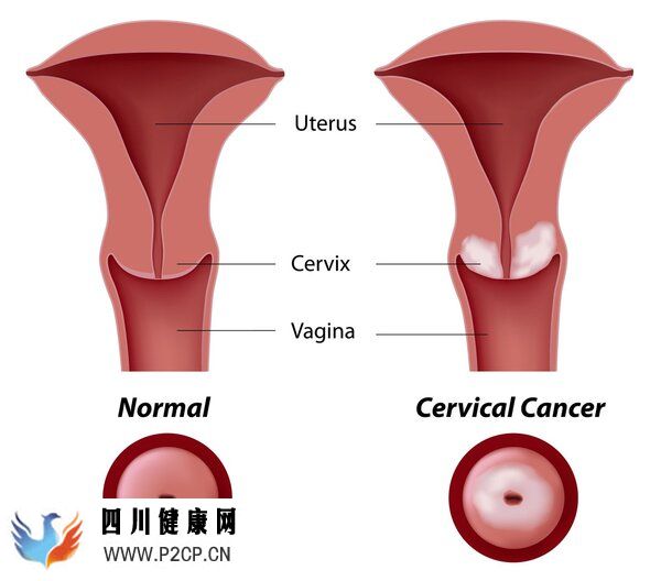 九價HPV疫苗降價！為什么有人打了，還患上宮頸癌？(圖8)